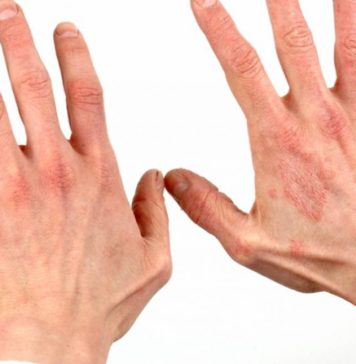 Cum tratăm psoriazisul?