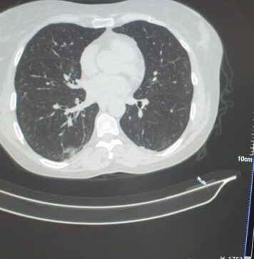 Doctorul Alexandru Andritoiu spune ca acum pacientii infectati cu virusul SARS-COV2 se prezinta cu o simptomatologie diferita fata de perioada anterioara
