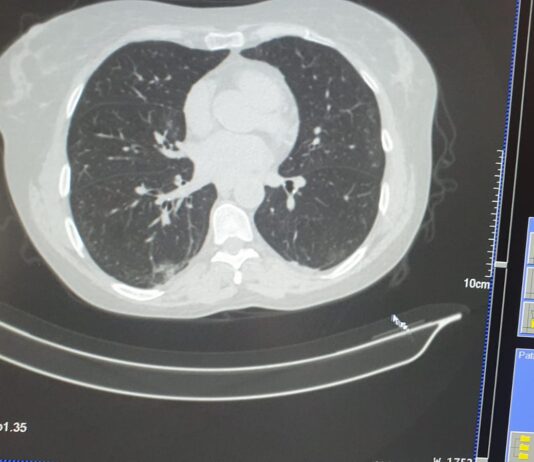 Doctorul Alexandru Andritoiu spune ca acum pacientii infectati cu virusul SARS-COV2 se prezinta cu o simptomatologie diferita fata de perioada anterioara