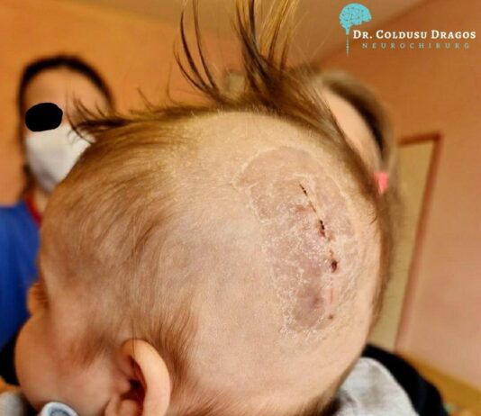 “În neurochirurgia pediatrică totul este diferit față de neurochirurgia adultului.Forța cu care lucrezi este redusă la minim, simțurile crescute la maxim. Trăirile sunt diferite atunci când ai sub câmpul steril un puiuț de om cu capul mai mic decât palma ta,” declara neurochirurgul Dragos Coldusu doctor intr-un spital din Herdecke – Dortmund