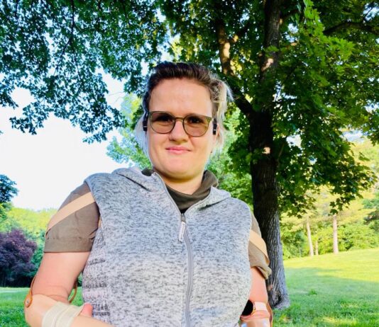 Povestea incredibila a Anei-Maria Raducu fata care in copilarie credea ca este normal sa nu ai maini pentru ca a crescut langa copii cu dizabilitati